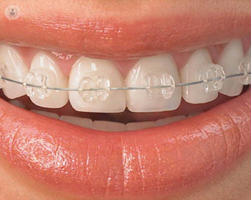 ortodoncia-estetica