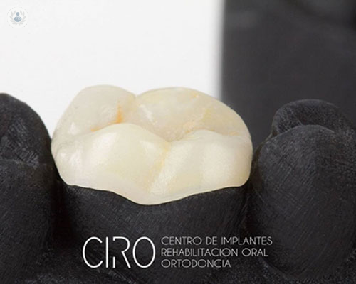 incrustaciones-dentales