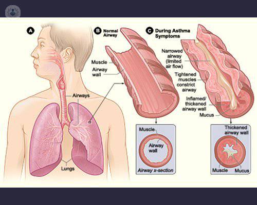 ¿Cuál es la relación entre el asma y la aspiración?
