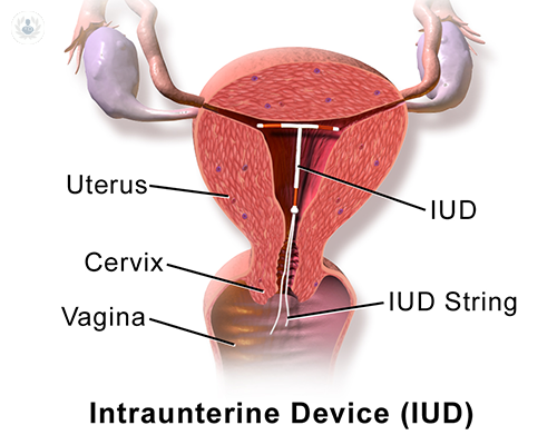 diu-dispositivo-intrauterino