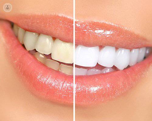 Blanqueamiento dental, cómo conseguir una sonrisa perfecta