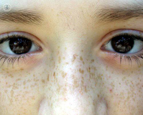 manchas-solares-en-la-piel-tratamiento