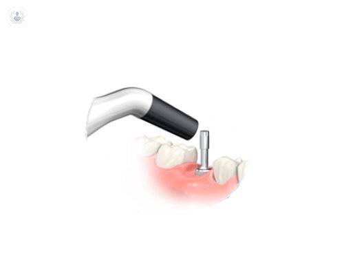 monitorizar-la-osteointegracion
