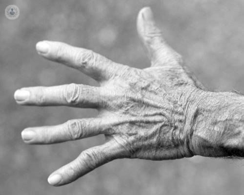 Artritis reumatoide: terapias biológicas para frenar su avance