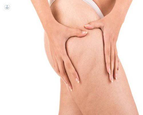 celulitis-mesoterapia