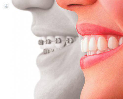 Ortodoncia en adultos y ortodoncia infantil