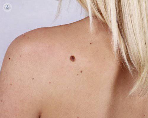 la-importancia-de-la-revision-periodica-de-los-lunares