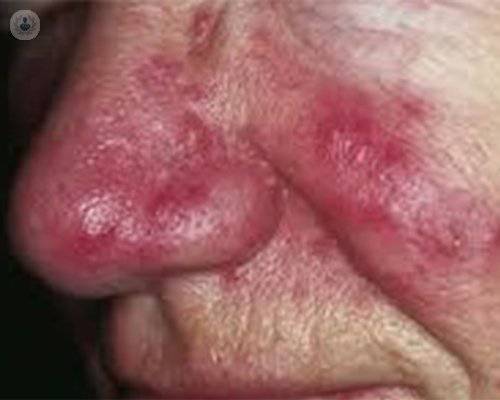la-rosacea-causas-y-tratamiento