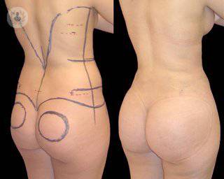 lipoescutura-pacientes-cuerpo-femenino