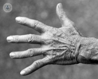 Las artritis: Todo lo que se necesita saber