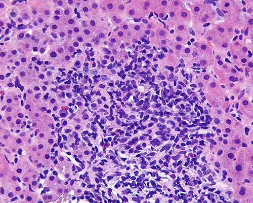 hepatitis-autoinmune