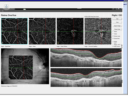 membrana-neovascular