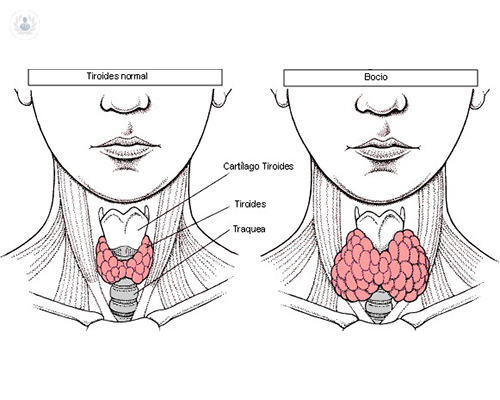 Cómo tratar el bocio multinodular