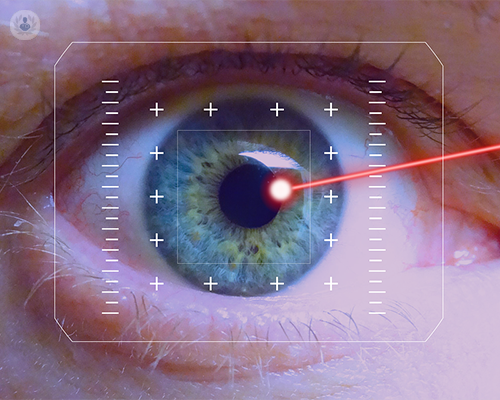 cirugia-laser-ojo