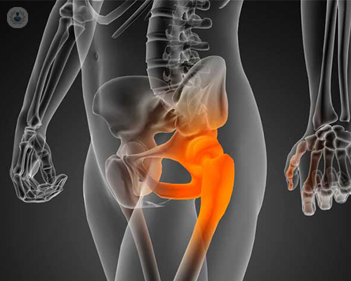 dolor-cadera-dolor-lateral-dolor-peritroacanterico-imagen