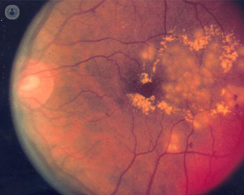 retinopatia-diabetica