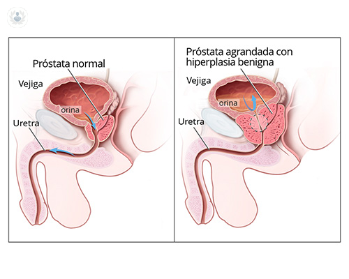 Benign Prostatic Hyperplasia: When the Prostate Grows More Than Normal