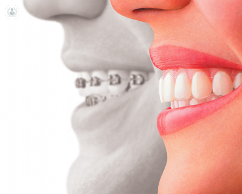 ortodoncia-invisible-adultos-estetica-sonrisa