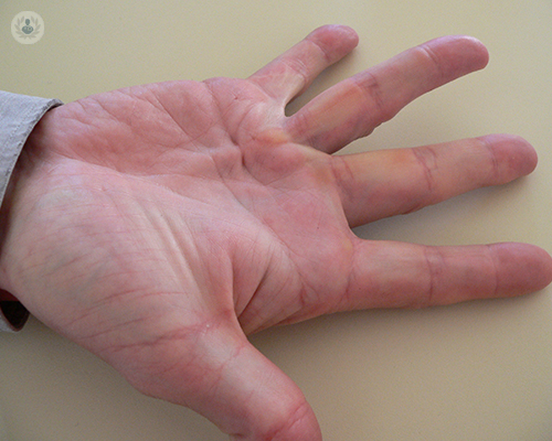 enfermedad-contractura-de-dupuytren-nodulo-palma-mano-dedos-flexionado
