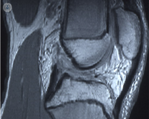 Lesión de ligamentos de la rodilla en niños