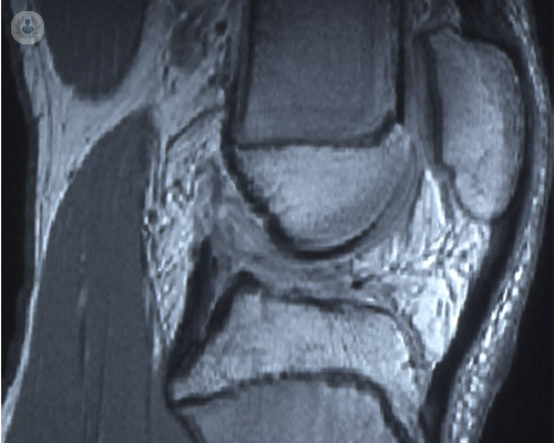 lesion-de-ligamentos-de-la-rodilla-en-ninos