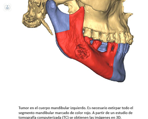 reconstruccion-facial-tumor