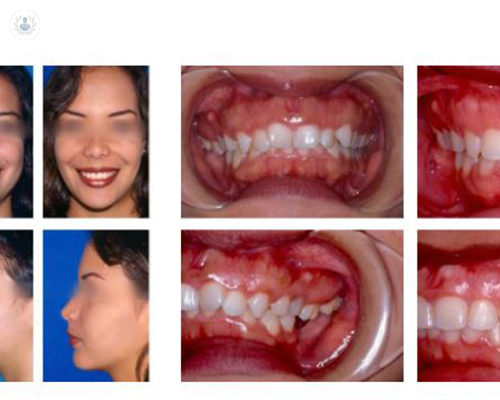 sonrisa-gingival