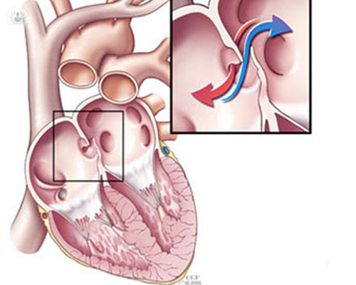 foramen-oval-permeable-fop
