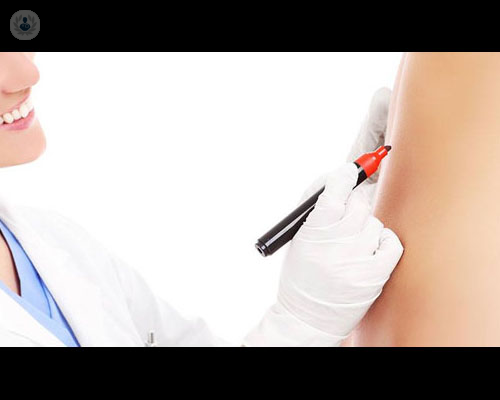 abdominoplastia