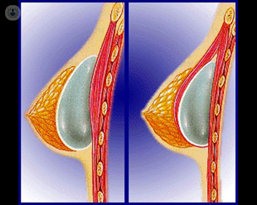 Mastopexia sin prótesis: Reposicionar los senos sin implantes