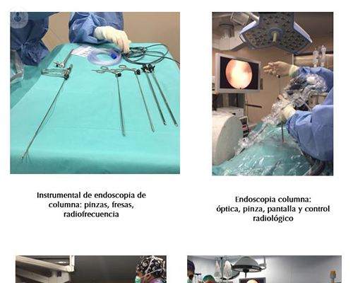 cirugia-endoscopica-columna