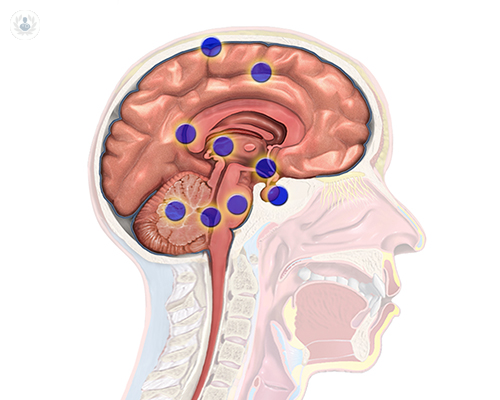 Cómo tratar los diferentes tipos de tumores cerebrales e intracraneales