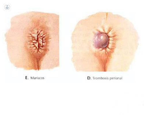 Cómo se manifiestan los diferentes tipos de hemorroides