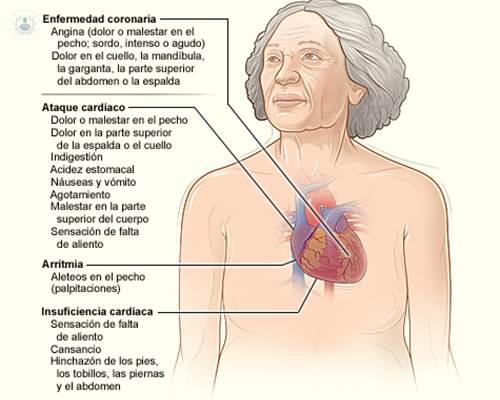 angina-de-pecho