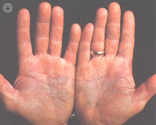Psoriasis: una enfermedad de la piel que puede controlarse