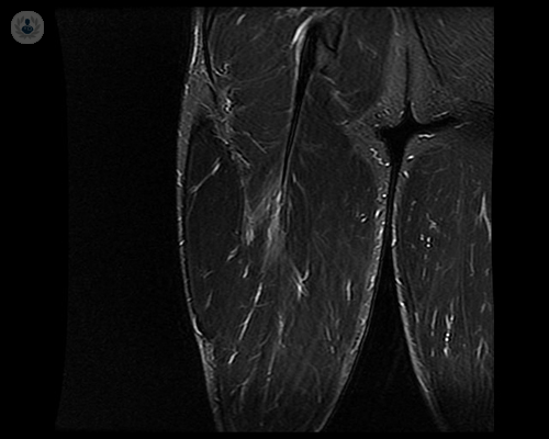 rotura-fibrilar-biceps-femoral