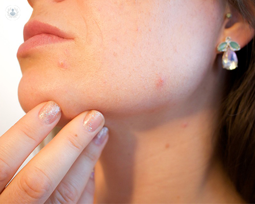 acabar-con-el-acne-es-posible