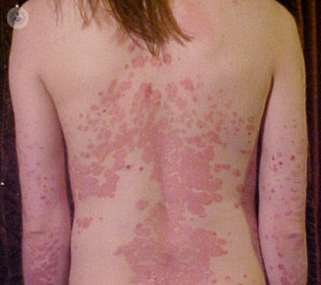 Psoriasis, la enfermedad de la piel