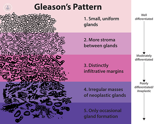 la-puntuacion-de-gleason-para-el-cancer-de-prostata