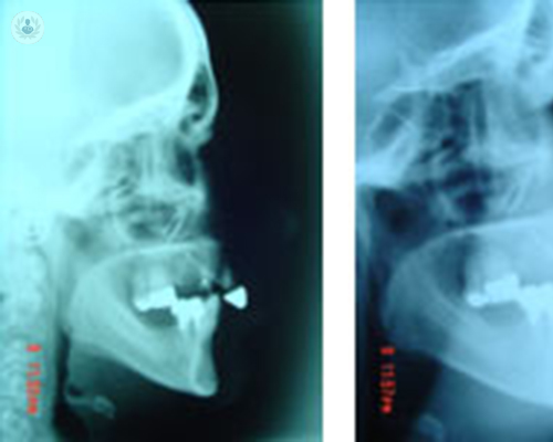 fases-de-la-cirugia-ortognatica