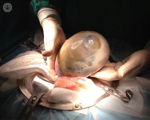 carcinomatosis-peritoneal-que-es