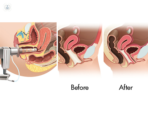 laser-co2-gnecologico