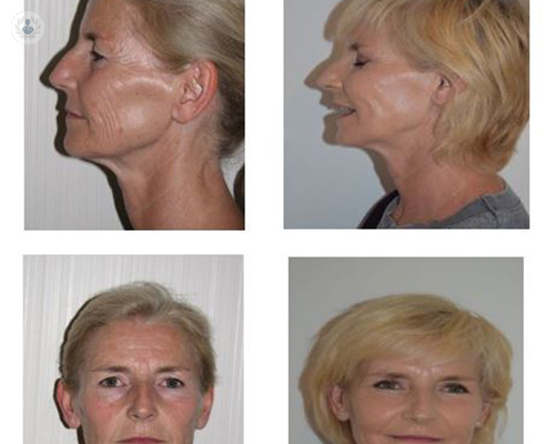 Resultado de la combinación de lifting facial con blefaroplastia y lifting de cejas