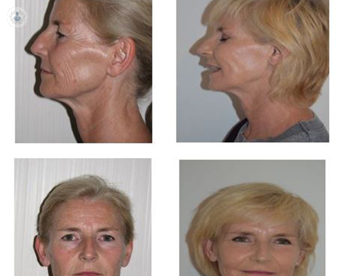 lifting-blefaroplastia