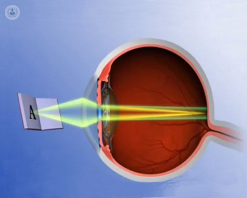 cirugia-con-lentes-multifocales