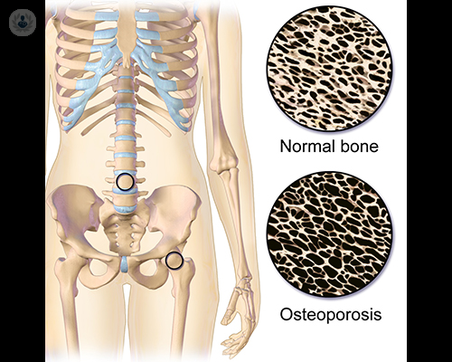 El papel del calcio en la osteoporosis