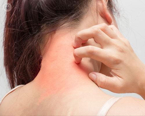 psoriasis-picor