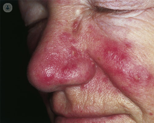 rosacea