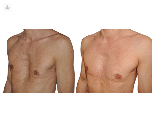 pectus-excavatum
