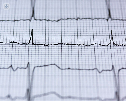 ¿Qué es un electrocardiograma y para qué sirve?